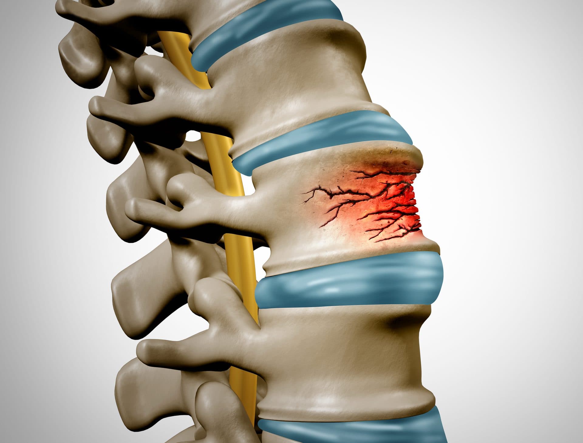 Vertebral Augmentation